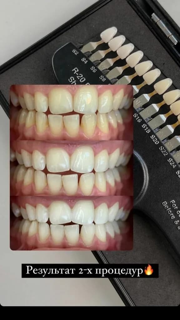 Студия косметического отбеливания зубов «My Brilliant Smile (Май Бриллиант Смайл)» — фото 5
