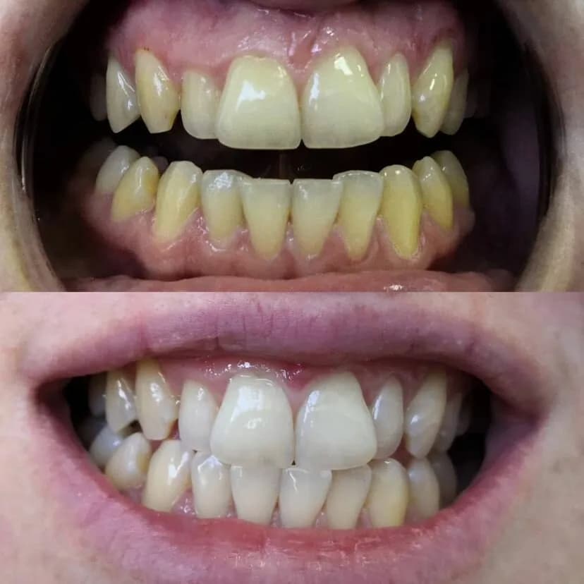 Студия косметического отбеливания зубов «My Brilliant Smile (Май Бриллиант Смайл)» — фото 6