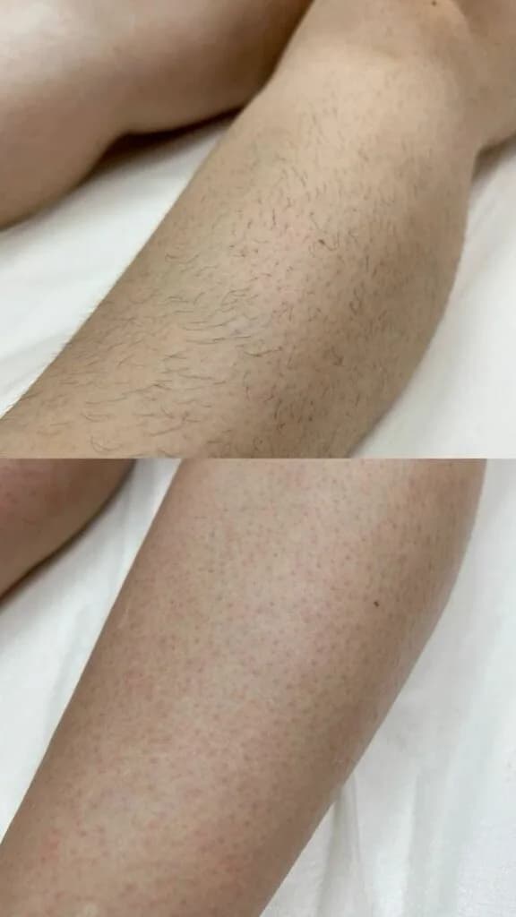 Эпиляция, депиляция